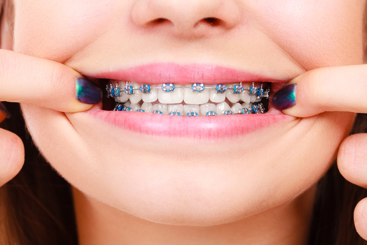 Orthodontics in Charles County and St. Mary’s County, MD