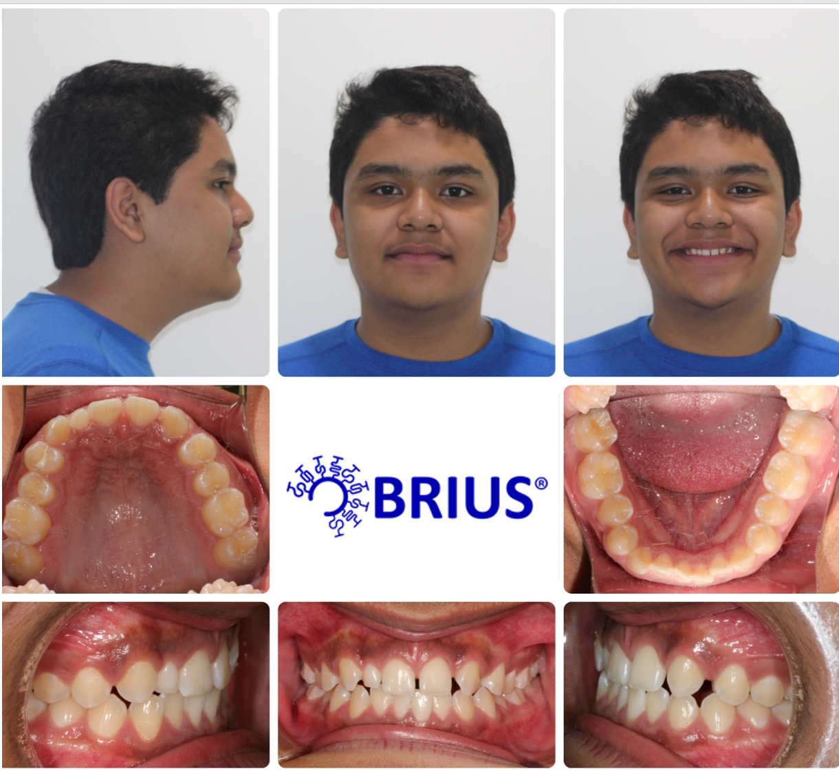 Brius® Charles in County, MD